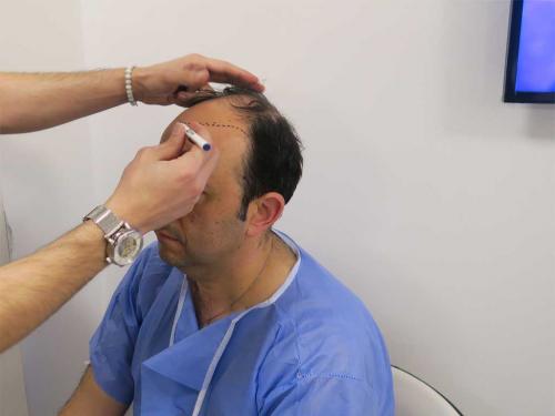 Trapianto Capelli FUE Istanbul