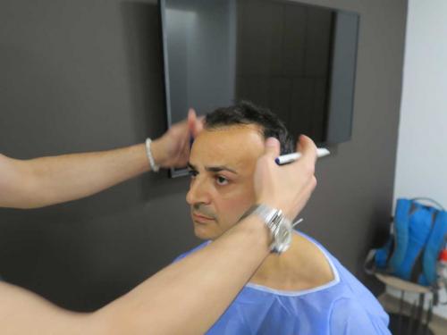 Trapianto Capelli FUE Istanbul